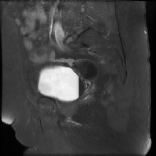 File:Bilateral ovarian dermoid cysts (Radiopaedia 90152-107338 Sagittal T1 C+ 8).jpg