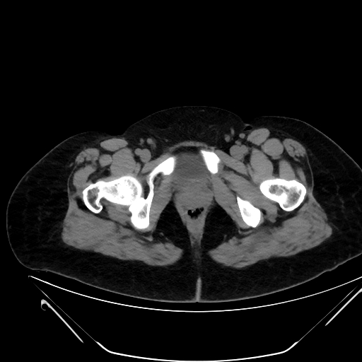 Bilateral ovarian mature cystic teratomas (Radiopaedia 79373-92457 Axial non-contrast 92).jpg