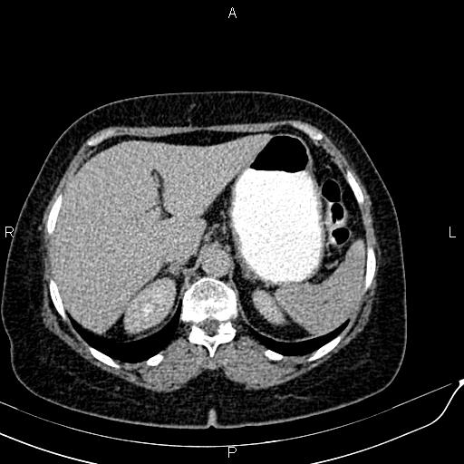 Bilateral ovarian serous cystadenocarcinoma (Radiopaedia 86062-101989 Axial C+ delayed 8).jpg