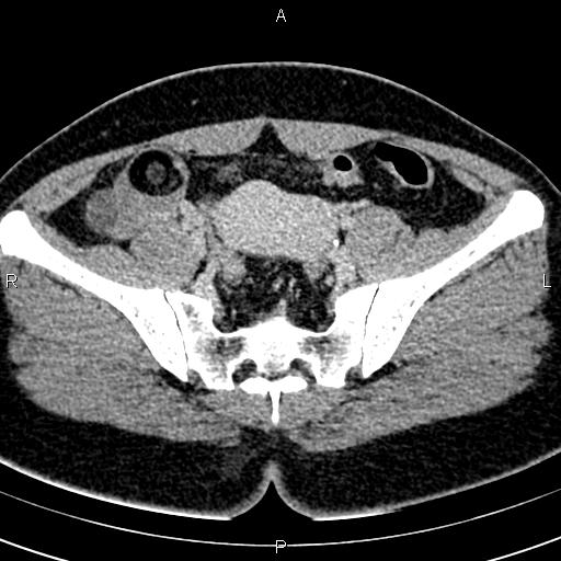 Bilateral ovarian teratoma (Radiopaedia 83131-97503 B 29).jpg