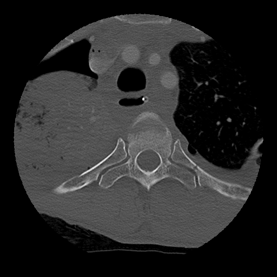 Bilateral perched facets with cord injury (Radiopaedia 45587-49713 Axial bone window 123).jpg