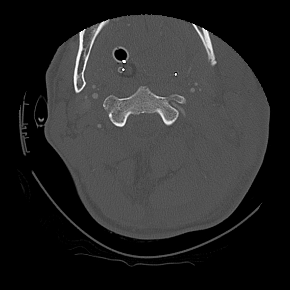 File:Bilateral perched facets with cord injury (Radiopaedia 45587-49713 Axial bone window 37).jpg