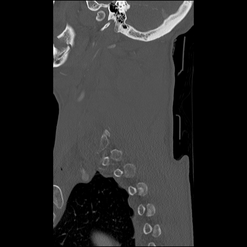 Bilateral perched facets with cord injury (Radiopaedia 45587-49713 Sagittal bone window 45).jpg