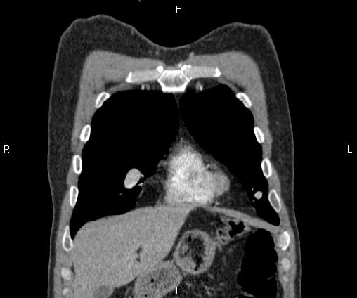 File:Bilateral pulmonary AVM (Radiopaedia 83134-97505 C 16).jpg