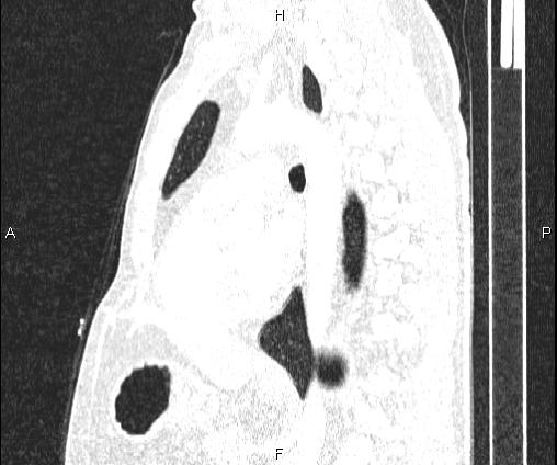 Bilateral pulmonary AVM (Radiopaedia 83134-97505 Sagittal lung window 66).jpg