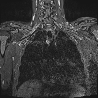 File:Bilateral spinoglenoid notch ganglion cysts (Radiopaedia 29577-30082 Coronal STIR 12).jpg