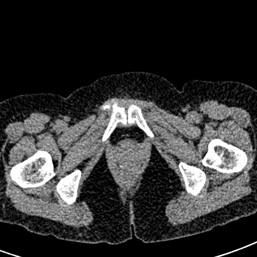 Bilateral staghorn calculi (Radiopaedia 59475-66842 Axial non-contrast 90).jpg