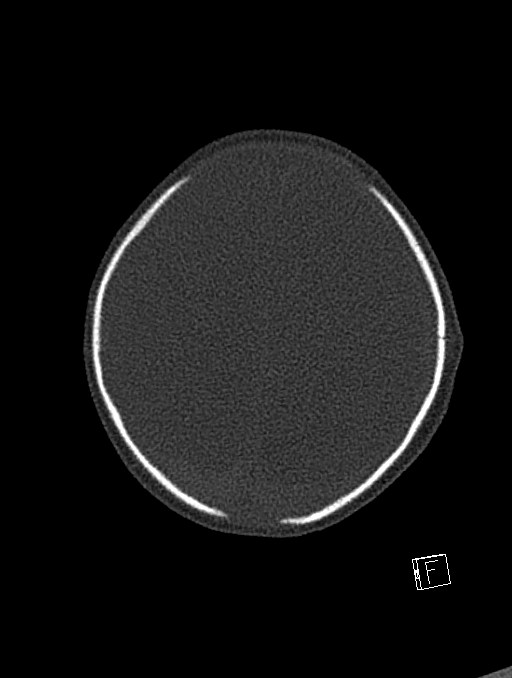 Bilateral subdural hemorrhage and parietal skull fracture (Radiopaedia 26058-26192 Axial bone window 24).png