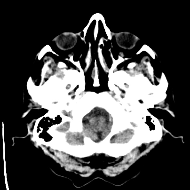 Bilateral subdural hygromata (Radiopaedia 29245-29656 Axial non-contrast 5).jpg