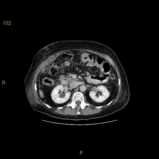 File:Biloma with drainage into the colon (Radiopaedia 20032-20068 A 2).jpg