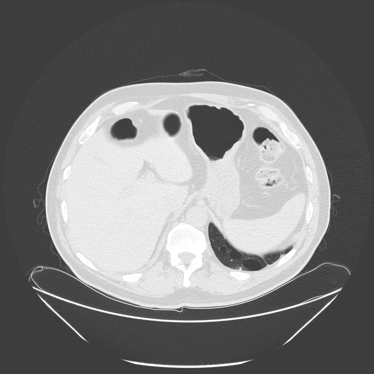 Birt-Hogg-Dubé syndrome (Radiopaedia 52578-58491 Axial lung window 60).jpg