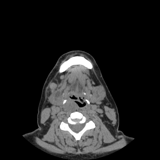 Bisphosphonate-related osteonecrosis of the jaw (Radiopaedia 71324-81642 non-contrast 17).jpg