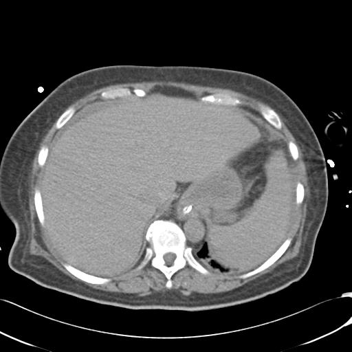 File:Bladder rupture post renal biopsy (Radiopaedia 30863-31572 Axial non-contrast 15).jpg