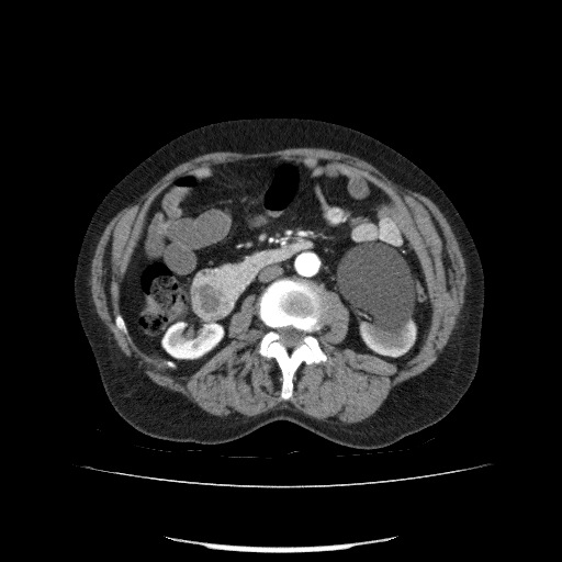 File:Bladder tumor detected on trauma CT (Radiopaedia 51809-57609 A 116).jpg