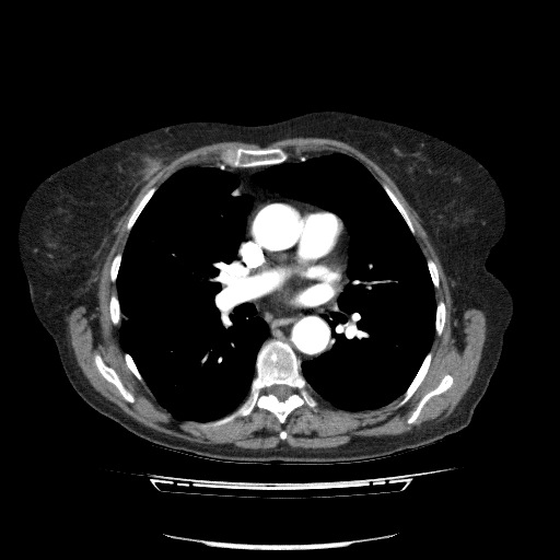 File:Bladder tumor detected on trauma CT (Radiopaedia 51809-57609 A 50).jpg