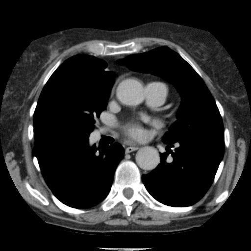 Bladder tumor detected on trauma CT (Radiopaedia 51809-57609 C 1).jpg