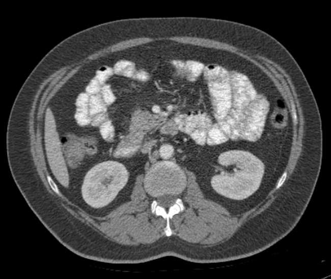 Bleeding duodenal ulcer and adenomyomatosis of gallbladder (Radiopaedia 61834-69861 A 53).jpg