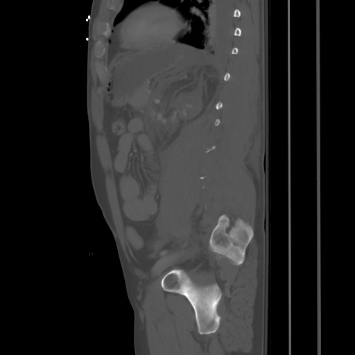 File:Blunt abdominal trauma with solid organ and musculoskelatal injury with active extravasation (Radiopaedia 68364-77895 Sagittal bone window 70).jpg