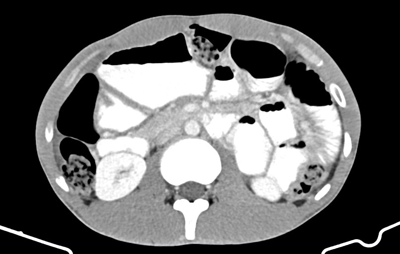 Blunt injury to the small bowel (Radiopaedia 74953-85987 A 69).jpg