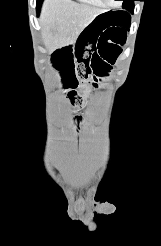 Blunt injury to the small bowel (Radiopaedia 74953-85987 B 18).jpg