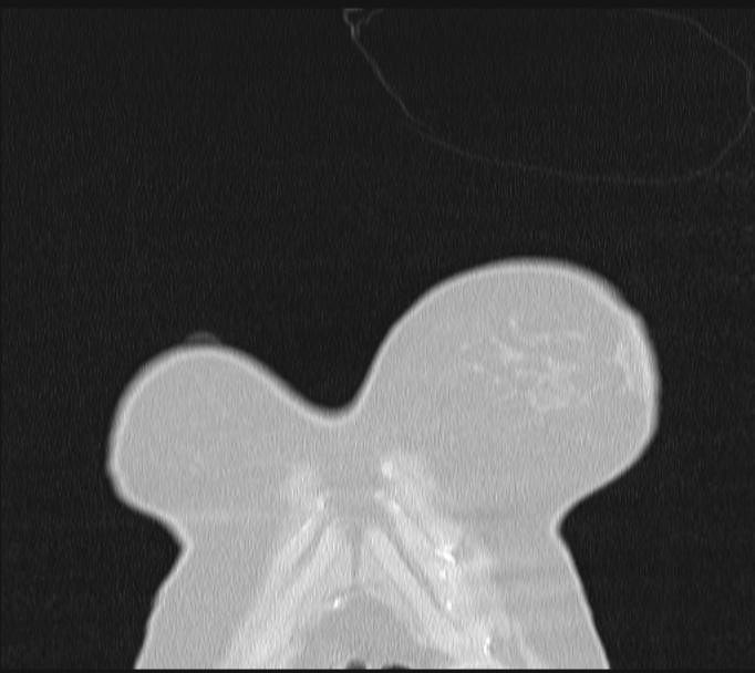 Boerhaave syndrome (Radiopaedia 45644-49799 Coronal lung window 1).jpg