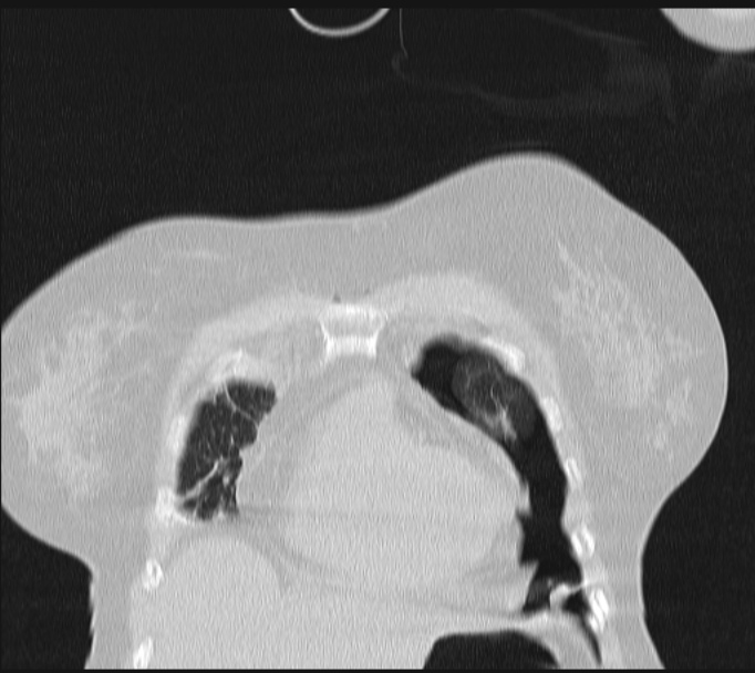 Boerhaave syndrome (Radiopaedia 45644-49799 Coronal lung window 13).jpg