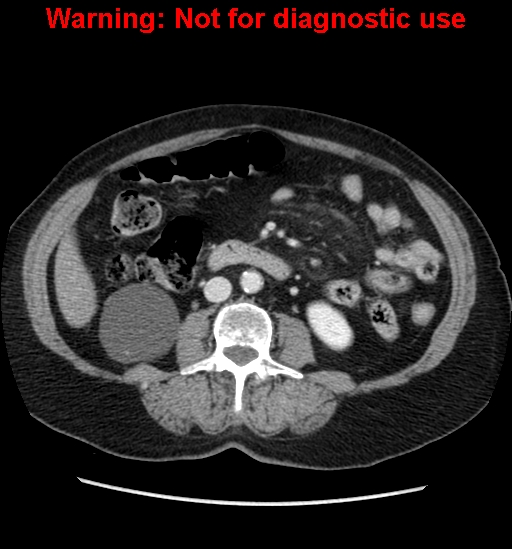 File:Bosniak renal cyst - type II (Radiopaedia 23404-23468 D 35).jpg