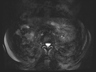 File:Bouveret syndrome (Radiopaedia 61017-68856 Axial MRCP 51).jpg