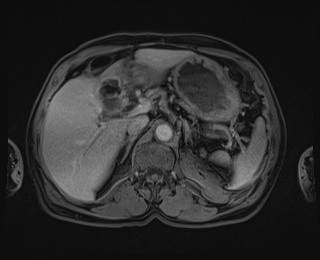 Bouveret syndrome (Radiopaedia 61017-68856 Axial T1 C+ fat sat 27).jpg