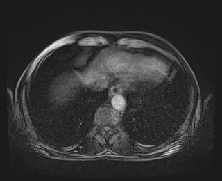 Bouveret syndrome (Radiopaedia 61017-68856 Axial T1 fat sat 5).jpg