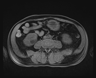 Bouveret syndrome (Radiopaedia 61017-68856 Axial T1 fat sat 58).jpg