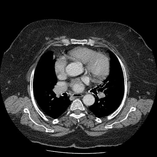 Bovine aortic arch - right internal mammary vein drains into the superior vena cava (Radiopaedia 63296-71875 A 75).jpg