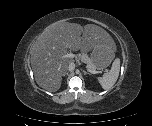 Bowel and splenic infarcts in acute lymphocytic leukemia (Radiopaedia 61055-68913 A 46).jpg