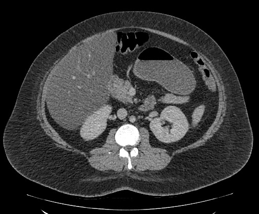 Bowel and splenic infarcts in acute lymphocytic leukemia (Radiopaedia 61055-68913 A 59).jpg