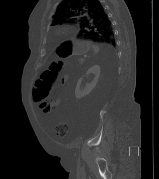 Bowel ischemia secondary to SMA occlusion with extensive portomesenteric venous gas (Radiopaedia 54656-60871 Sagittal bone window 26).jpg