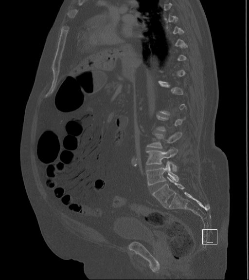 Bowel ischemia secondary to SMA occlusion with extensive portomesenteric venous gas (Radiopaedia 54656-60871 Sagittal bone window 58).jpg