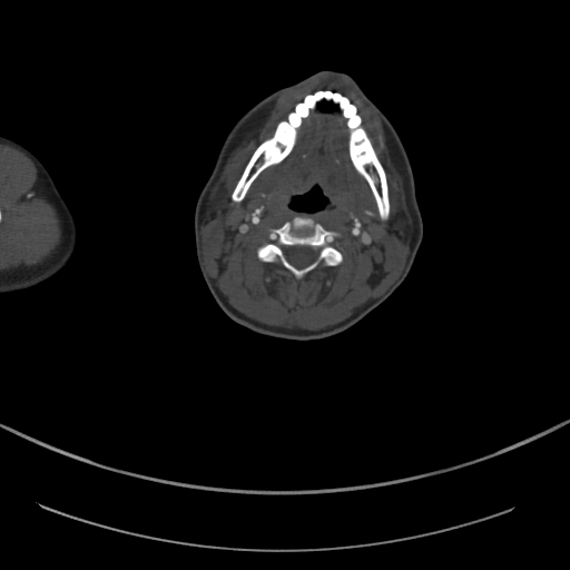 File:Brachiocephalic trunk pseudoaneurysm (Radiopaedia 70978-81191 Axial bone window 9).jpg