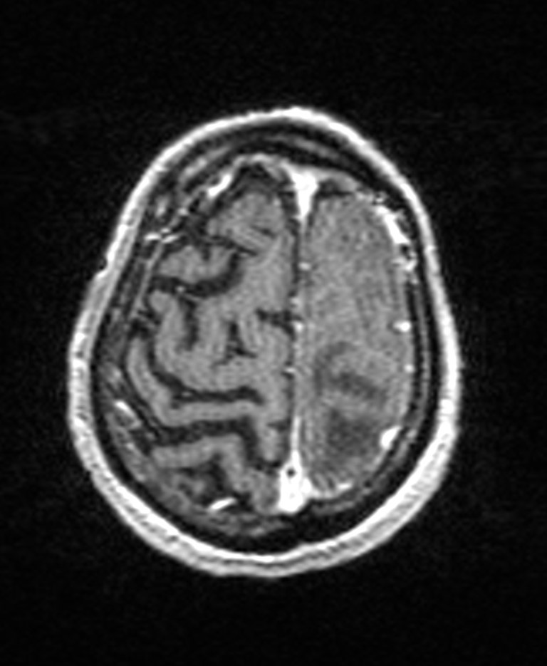 Brain abscess with dual rim sign (Radiopaedia 87566-103938 Axial T1 C+ 138).jpg