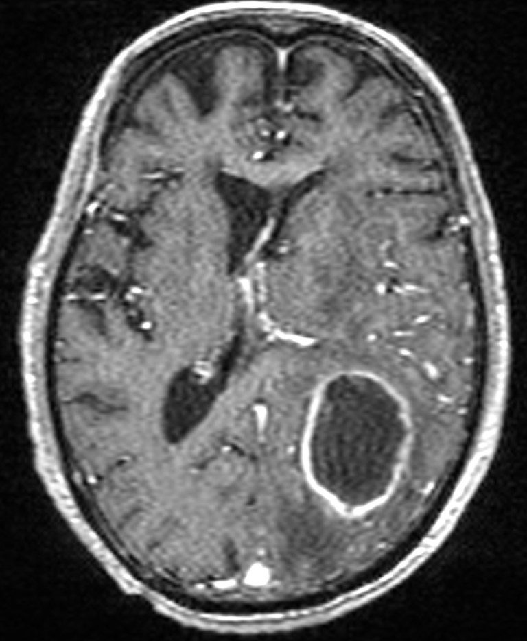 Brain abscess with dual rim sign (Radiopaedia 87566-103938 Axial T1 C+ 92).jpg
