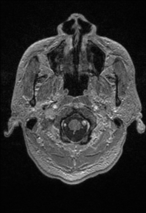 Brain abscess with ventriculitis (Radiopaedia 85703-101495 Axial T1 C+ 19).jpg