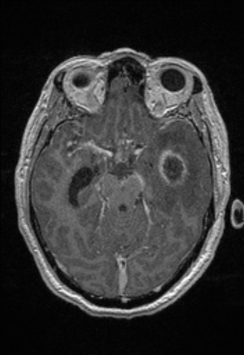 Brain abscess with ventriculitis (Radiopaedia 85703-101495 Axial T1 C+ 71).jpg