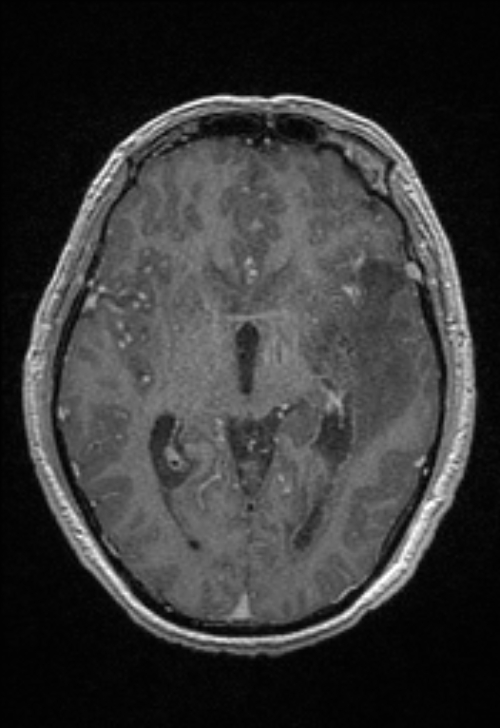 Brain abscess with ventriculitis (Radiopaedia 85703-101495 Axial T1 C+ 86).jpg