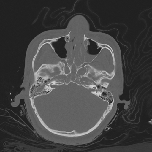 Brain contusions, internal carotid artery dissection and base of skull fracture (Radiopaedia 34089-35339 Axial bone window 55).png
