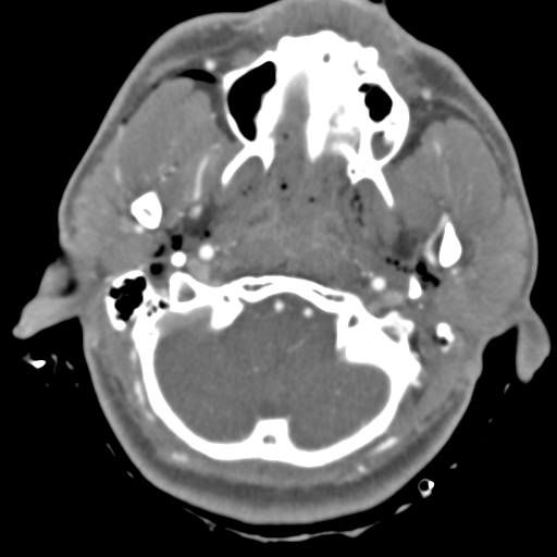 Brain contusions, internal carotid artery dissection and base of skull fracture (Radiopaedia 34089-35339 D 49).png