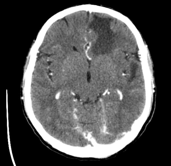 File:Brain metastases from lung cancer (Radiopaedia 24480-24781 Axial C+ delayed 25).jpg
