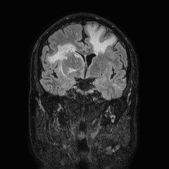 Brain metastases from lung cancer (Radiopaedia 83839-99028 Coronal FLAIR 34).jpg