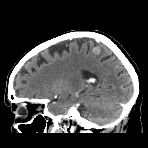 Brain metastasis (Radiopaedia 42617-45760 D 17).jpg