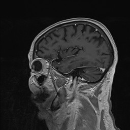 Brain metastasis (Radiopaedia 42617-45761 Sagittal T1 C+ 73).jpg