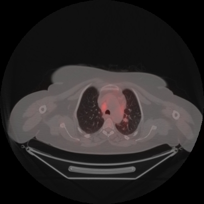 Brain metastasis (Radiopaedia 89847-106962 Axial lung window 14).jpg