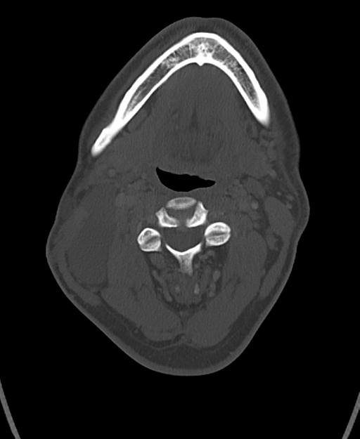 Branchial cleft cyst (Radiopaedia 31167-31875 Axial bone window 30).jpg